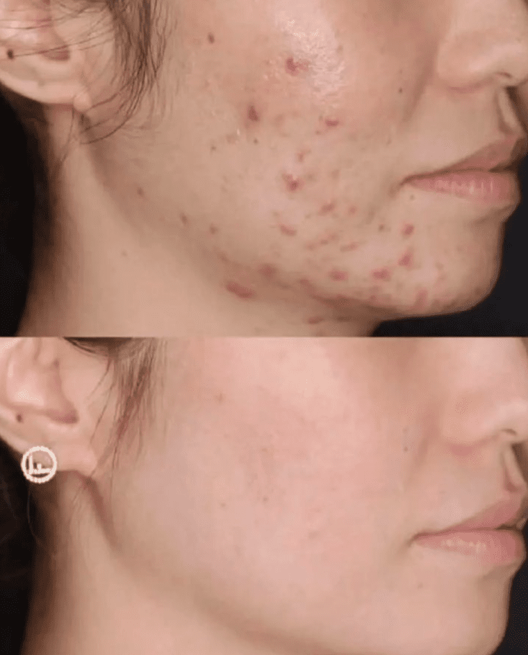 Yet Another Before and After