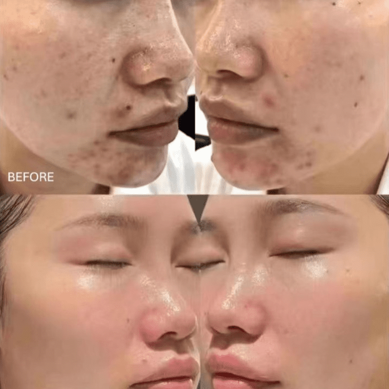 Bio-Spicule Treatment Results - Before & After