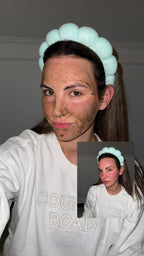 Liquid microneedling spicule treatment