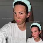 Spicule treatment bio microneedling