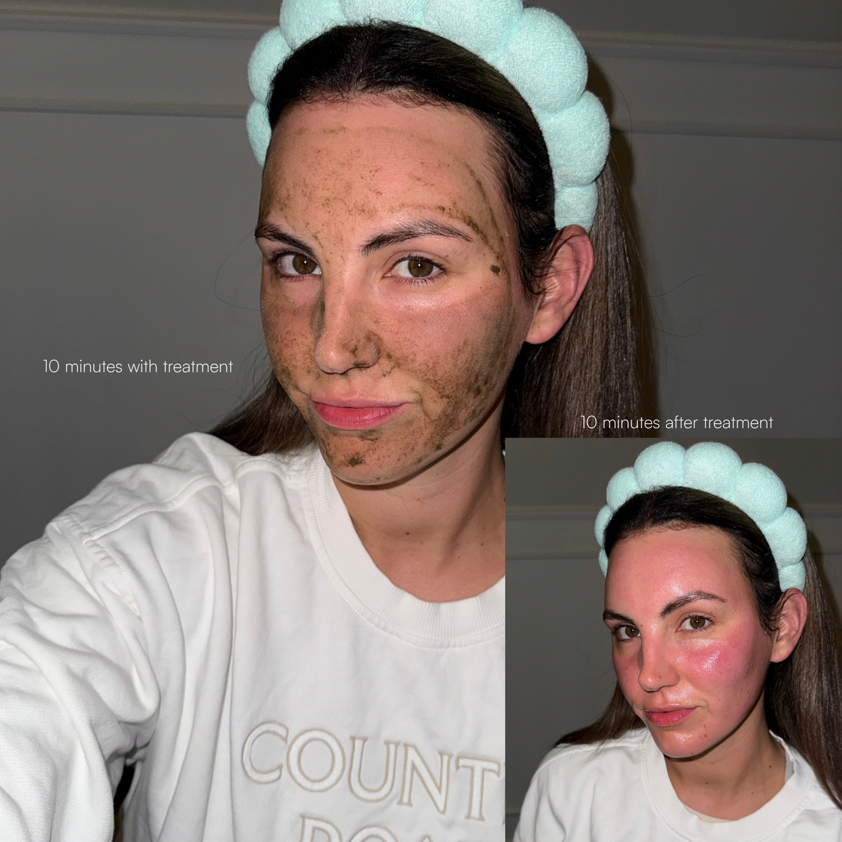 Spicule treatment bio microneedling